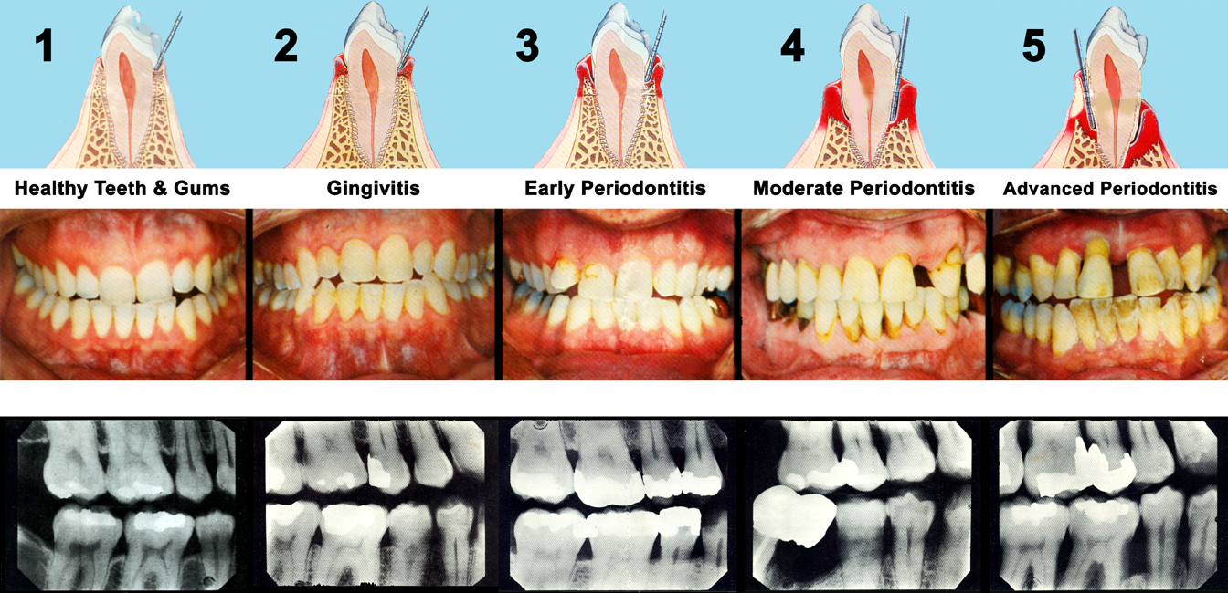 Deep Cleanings Stop Bone Loss Due To Periodontal Disease Jennifer