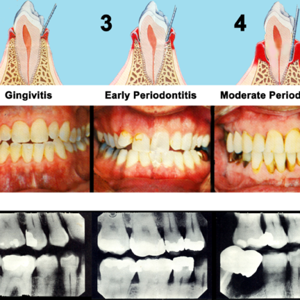 Periodontitis Stages - Jennifer Chiang, DDS