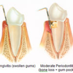 Periodontitis Stages