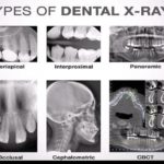 Xrays