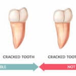 cracked-tooth