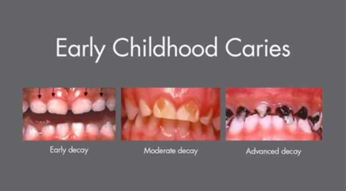 Early Childhood Caries fixed by Sunnyvale Functional Dentist Jen Chiang DDS